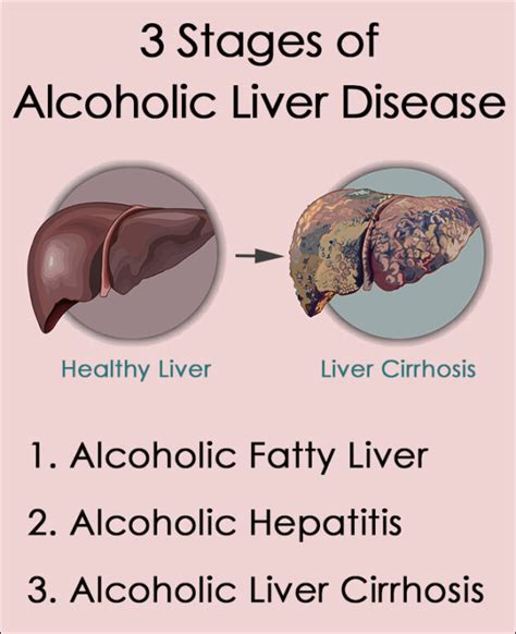 Alcoholic Liver Disease: Reversibility, Signs, Stages.